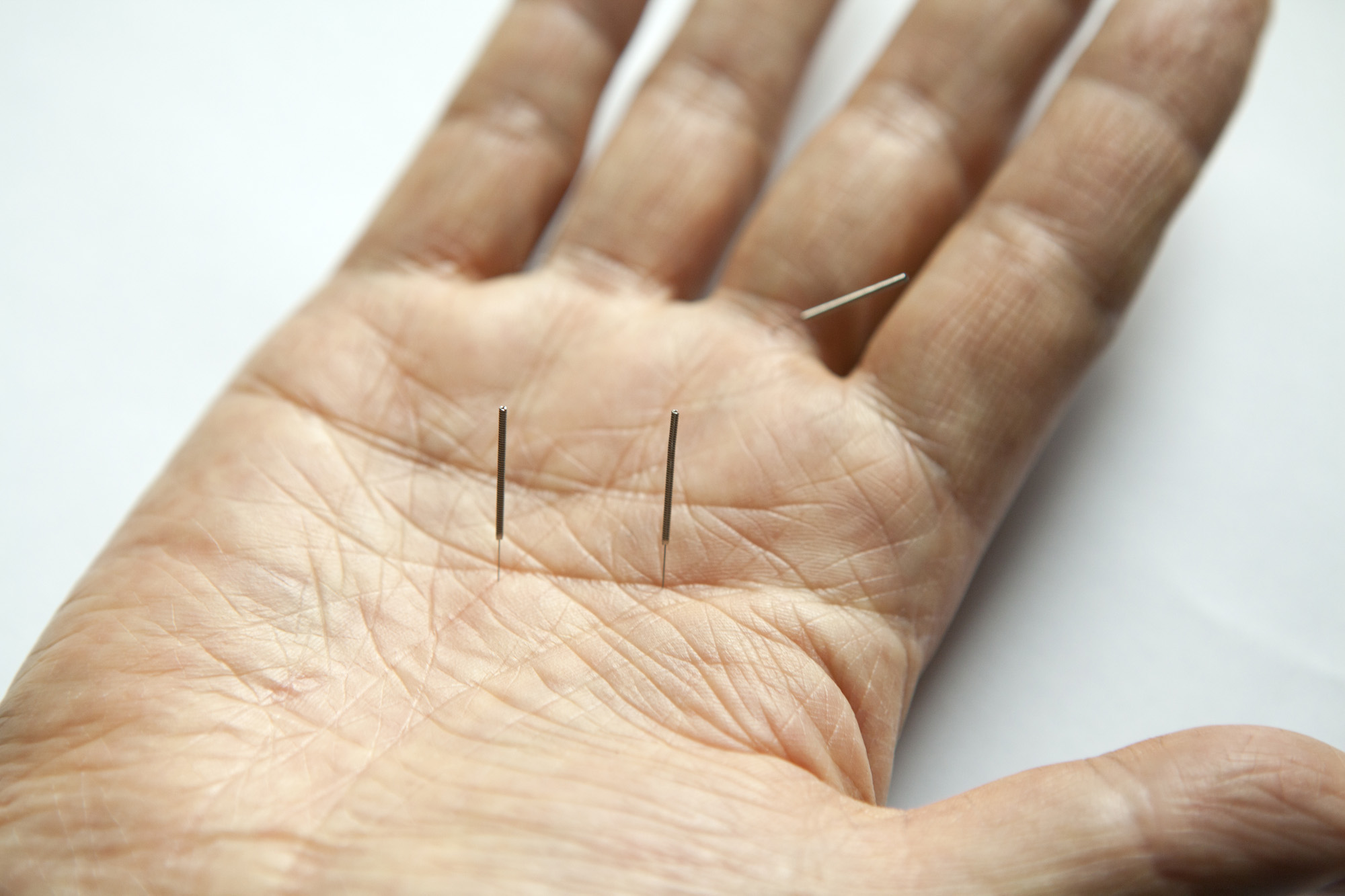 Acupuncture Therapy: A Natural Approach to Healing